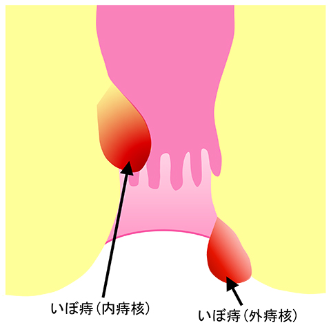 いぼ痔（痔核）