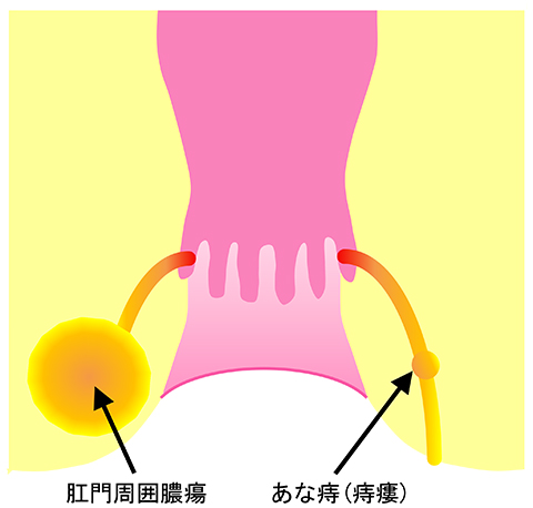 あな痔