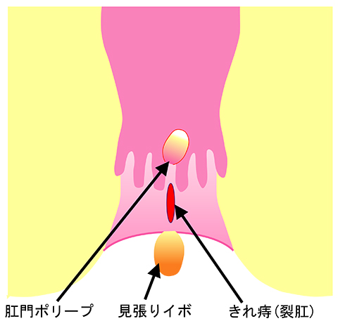 きれ痔